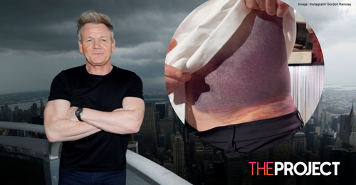 Gordon Ramsay Shows Off Gruesome Bruising After 'Really Bad' Cycling Accident